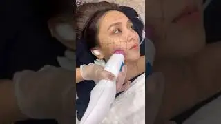 Katryn Bernardo l AIVEE THERMAGE FLX