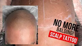 Scalp Micropigmentation Flawless SMP Vancouver Behind the Scenes of a Hair Loss Treament Full Hair