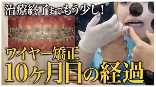 【治療10ヶ月】治療終了までもう少し！ワイヤー矯正の経過は？【名古屋ルミナス歯科・矯正歯科】