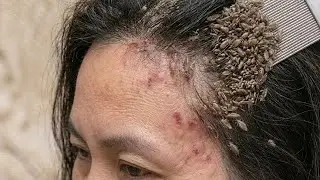 Head lice treatment, removal 