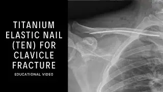 Titanium Elastic Nail (TEN) for Clavicle Fracture