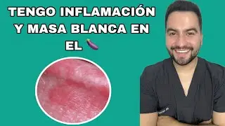 TENGO INFLAMADO EL PREPUCIO Y LA CABEZA DE MI PENE / BALANOPOSTITIS | DR. DAVID CAMPOS