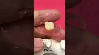Replaced from metal to flexible partial