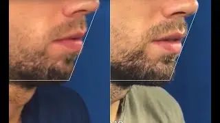 Voor & Na - Behandeling kin + kaaklijn | Joost Kroon cosmetische kliniek