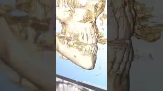 Dental Dictionary 📖🦷: CBCT (Cone Beam Computed Tomography) #expressdentallab