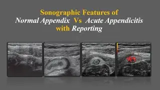 Ultrasound Features of Normal Appendix vs Acute Appendicitis | Sonography & Reporting