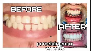 EMAX PORCELAIN VENEERS/ TEETH TRANSFORMATION