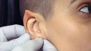 Elf Ear surgery the new fad in body modification