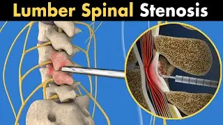 MILD procedure of lumber spinal stenosis (3D animation)
