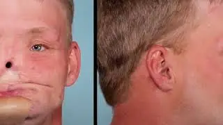 Face transplant recipient has tearful meeting with donor's widow
