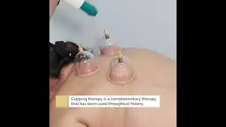 Dry Cupping at The Health Suite