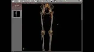 CT Angiography Case07 Peripheral Arterial Occlusive Disease PAOD Chronic Lower Limb Ischemia