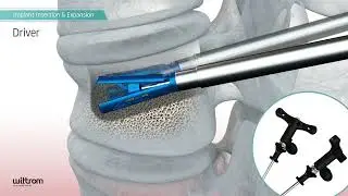 TRIPOD FIX Vertebral Body Augmentation System
