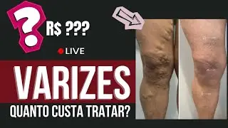 Quanto custa o tratamento de Varizes?