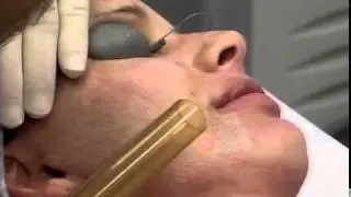 Gioi thieu ve Sciton Micro Laser Peel - Sciton Micro Laser Peel Introduction