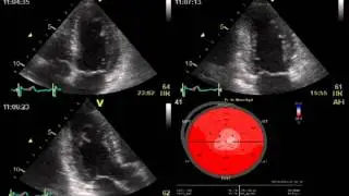 SPECKLE TRACKING ECHOCARDIOGRAPHY / HEART FUNCTION