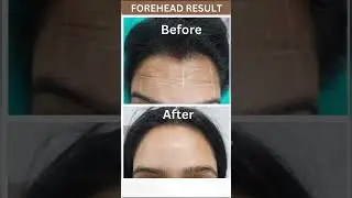 #botox #fillers #fillersinjection #botoxfiller#dermatologist #likeforlikes #viralvideo #viralshorts