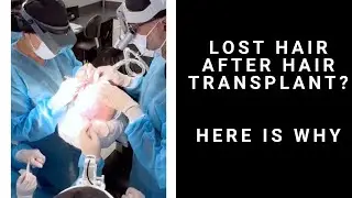 What to do if you are Losing Hair Post FUE Hair Transplant?