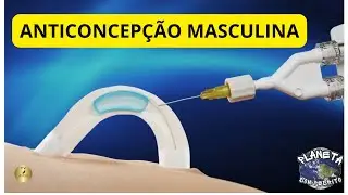 ANTICONCEP&Ccedil;&Atilde;O MASCULINA
