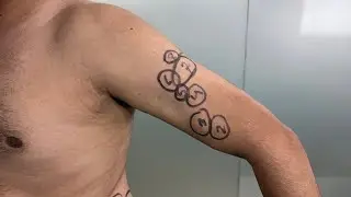 🔴Live Multiple Lipoma Removal After procedure #lipoma #lipomatreatment #getridoflipoma #lumps