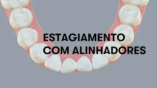 Estagiamento com alinhadores