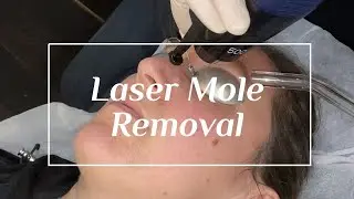 Laser Mole Removal