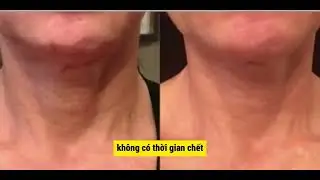 Fraxis Duo - Phương ph&aacute;p trẻ h&oacute;a t&aacute;i tạo to&agrave;n diện nhất