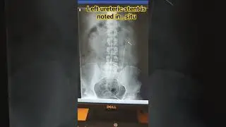 x ray KUB #xray #digitalimaging #medicalimageprocessing #xraytechnician #shortvideo #2024 #viralvide
