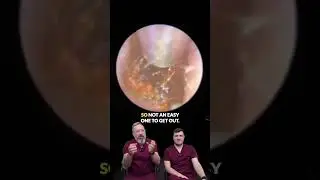 Watch This Ear Wax Removal