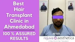 NRI from USA came to Ahmedabad for his Hair Transplantation done by Dr. Arth Shah #shorts #ytshorts