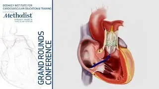Update on Trans-catheter Interventions in Congenital Heart Disease (J. Aboulhosn, MD) Feb 21, 2019