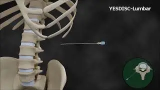 YES DISC Lumbar catheter