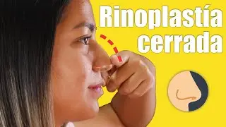 RINOPLASTÍA CERRADA 👃🏼Le cambió el rostro  😍 Dr. Percy Nevado / Cirugía Plástica Nevado
