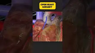 Open Heart Surgery Explained