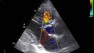 Right ventricular floating mass. What is it? - Dr. Alexandru Mischie