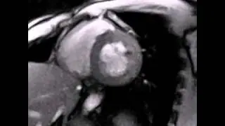 Real-time MRI - Going live to the beating heart