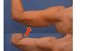 J PLASMA BACK AND ARMS AT ONE MONTH (NO BRACHIOPLASTY SCARS)