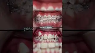 Can crooked teeth cause health problems?