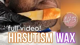 Hirsutism Wax | Full Process | From Live Session #FaceWax #PCOSWax