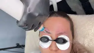 Picosecond laser machine / eyebrow tattoo removal full process