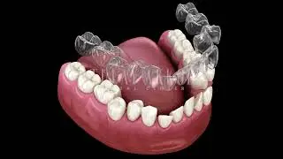 T&uuml;lay Akkol Dental - Invisalign Treatment