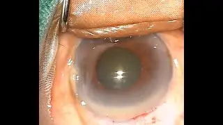 Intratunnel Phacofracture MSICS in a Small Pupil Cataract HD Unedited