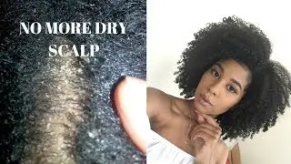 NO MORE FLAKES | BEST SHAMPOO FOR DRY AND ITCHY SCALP