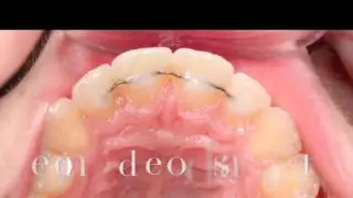 Incognito Braces and 3D Printing at The Orthodontic Centre
