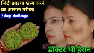 7 दिन में 10 साल पुराने झाइयां, दाग-धब्बे निसान को जड़ सेखत्म करें/How to  Remove pigmentation