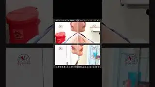 Pdo Threads Facelift | Miami #beyondhealthmedspa #pdo