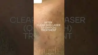 Clear Skin Laser Q-Switch treatment is the perfect solution to reduce acne marks and pigmentation.