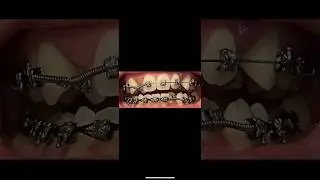Braces Time Lapse: 20 Months!