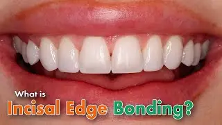 What is incisal edge bonding?