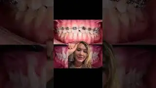Rotated and chipped tooth #teeth #braces #braceson #bracesoff #ortho #orthodontist